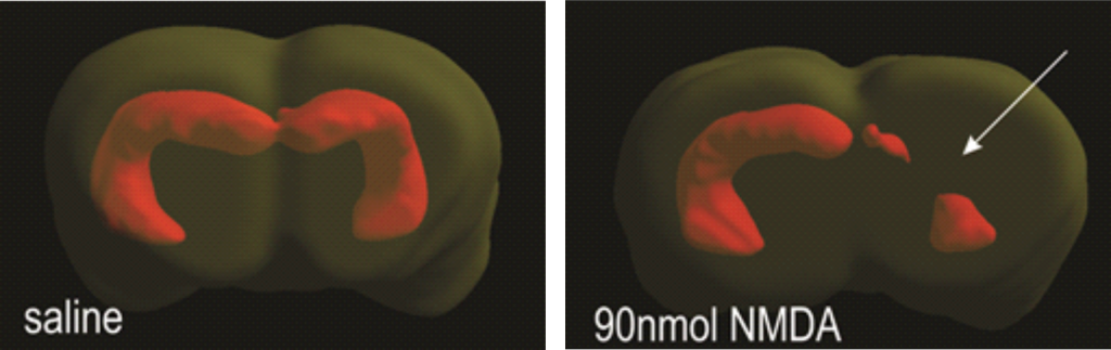 Důsledky časného poškození mozku a prevence vzniku epilepsie - casne poskozeni mozku